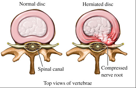 What surgical options are available for a herniated disc?