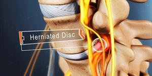 When Surgery is the Right Treatment for Your Herniated Disc